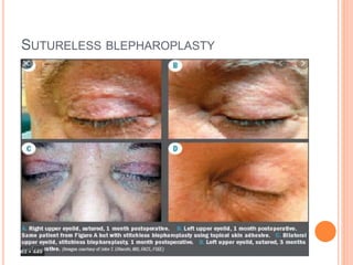 SUTURELESS BLEPHAROPLASTY
 