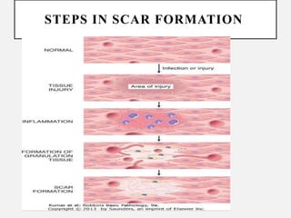 Comprehensive Overview of Tissue Repair and Wound Healing Processes | PPTX