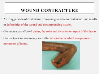 Contractures Examples Comprehensive Overview of Tissue Repair and Wound Healing Processes | PPTX