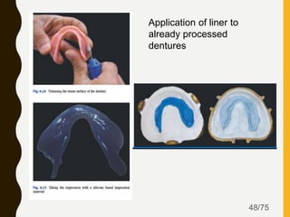 48/75
Application of liner to
already processed
dentures
 
