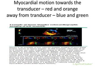 Myocardial motion towards the
transducer – red and orange
away from tranducer – blue and green
 
