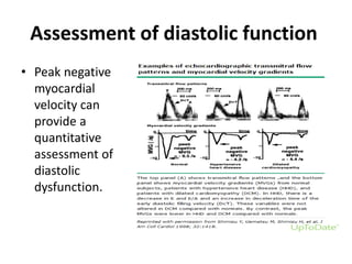 Assessment of diastolic function
• Peak negative
myocardial
velocity can
provide a
quantitative
assessment of
diastolic
dysfunction.
 