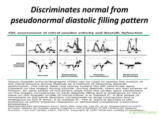 Discriminates normal from
pseudonormal diastolic filling pattern
 
