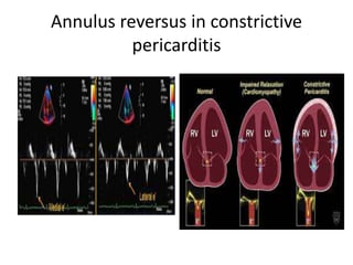 Annulus reversus in constrictive
pericarditis
 