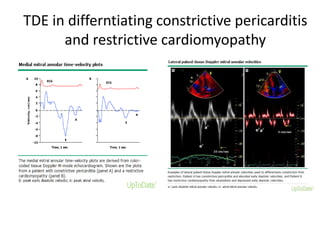 TDE in differntiating constrictive pericarditis
and restrictive cardiomyopathy
 