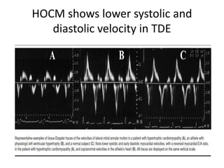 HOCM shows lower systolic and
diastolic velocity in TDE
 