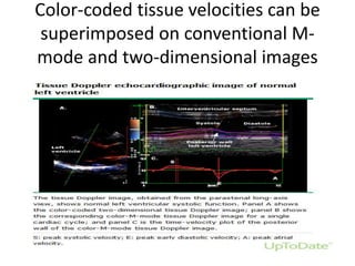 Color-coded tissue velocities can be
superimposed on conventional M-
mode and two-dimensional images
 