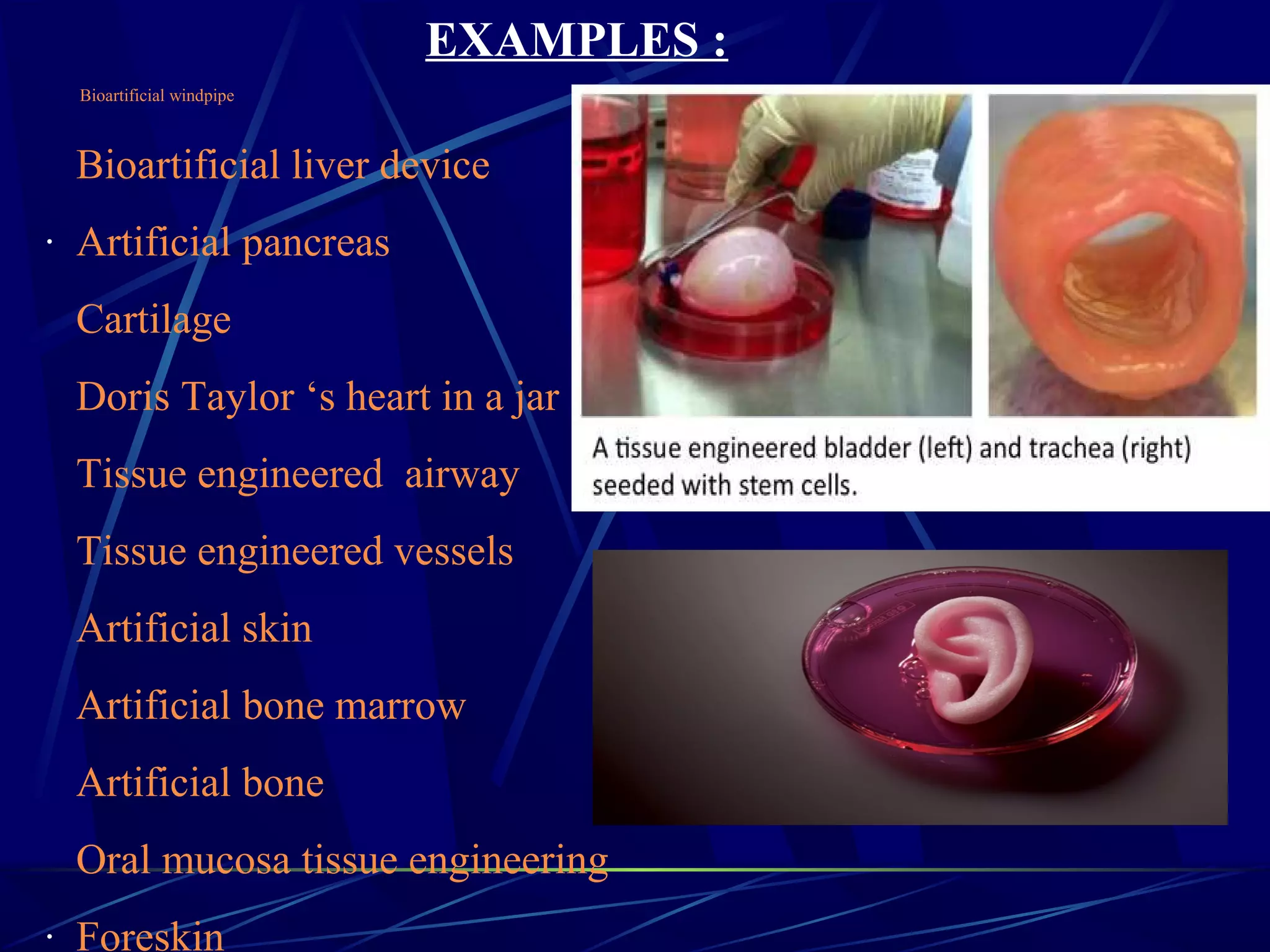 Bioartificial windpipe
Bioartificial liver device
· Artificial pancreas
Cartilage
Doris Taylor ‘s heart in a jar
Tissue engineered airway
Tissue engineered vessels
Artificial skin
Artificial bone marrow
Artificial bone
Oral mucosa tissue engineering
· Foreskin
EXAMPLES :
 