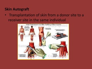 Skin Autograft
• Transplantation of skin from a donor site to a
receiver site in the same individual
 