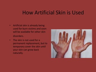 How Artificial Skin is Used
• Artificial skin is already being
used for burn victims and soon
will be available for other skin
disorders.
• The skin is not used for a
permanent replacement, but to
temporary cover the skin until
your skin can grow back
naturally.
 