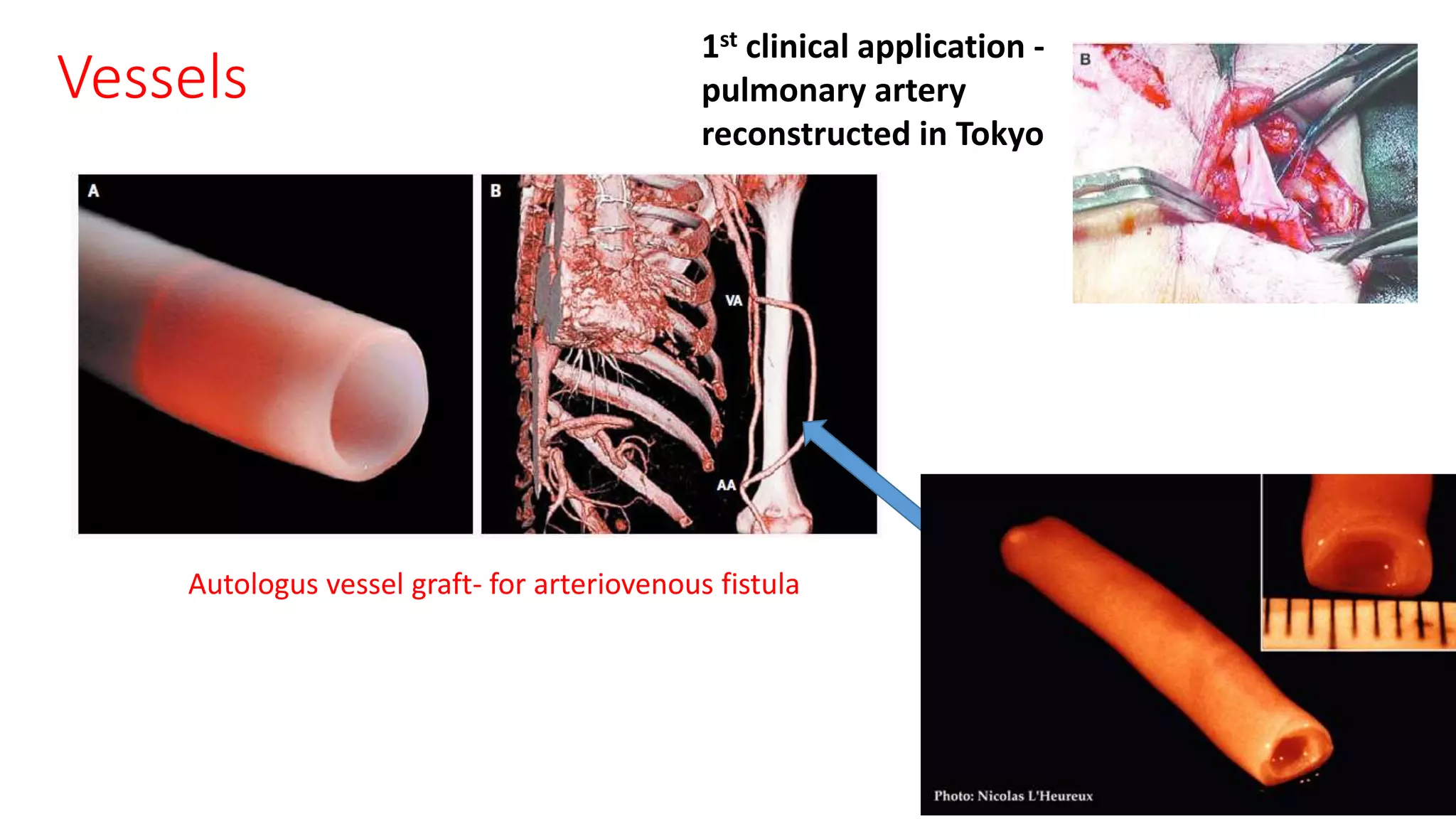 Vessels
Autologus vessel graft- for arteriovenous fistula
1st clinical application -
pulmonary artery
reconstructed in Tokyo
 
