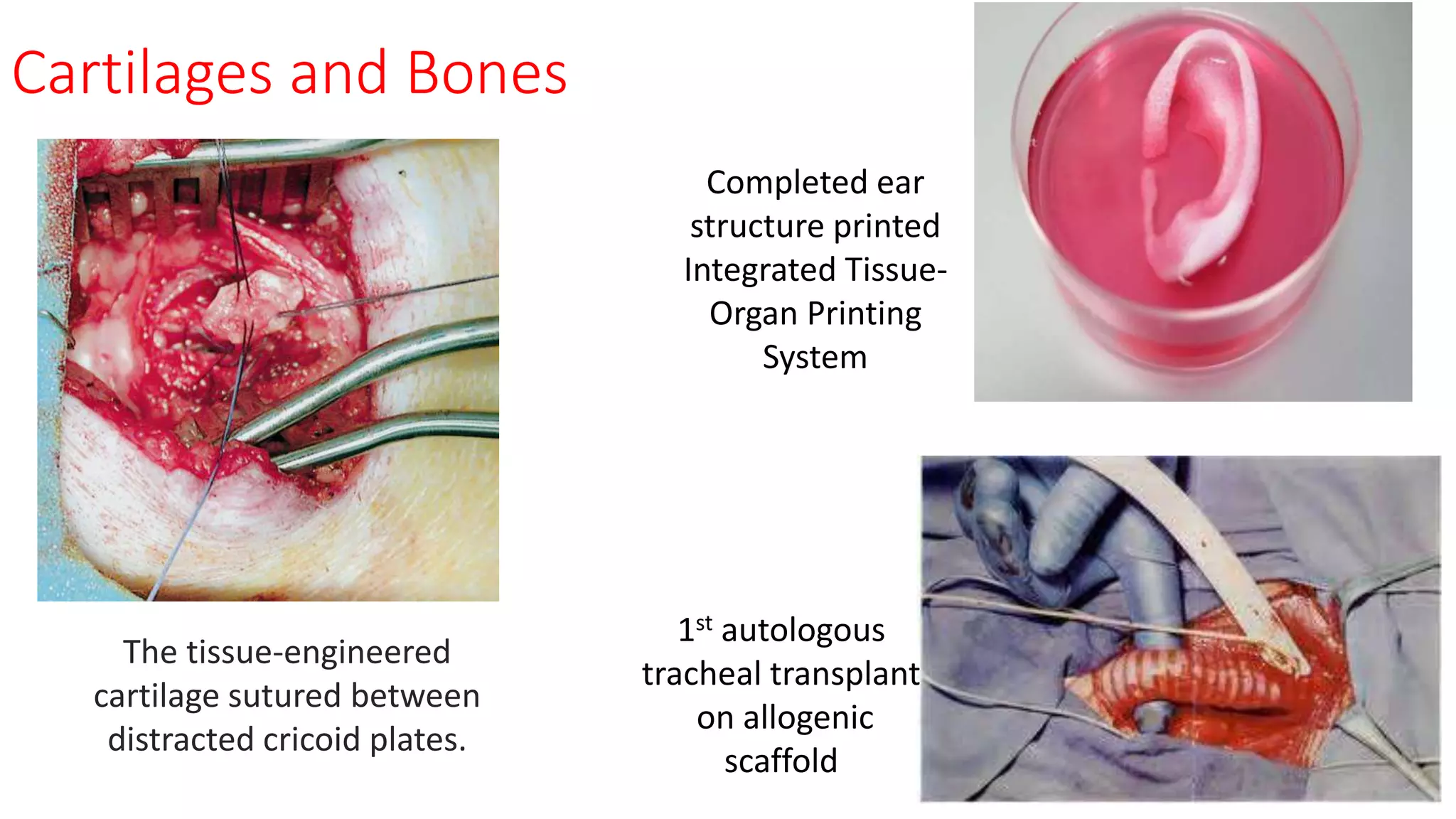 Cartilages and Bones
The tissue-engineered
cartilage sutured between
distracted cricoid plates.
Completed ear
structure printed
Integrated Tissue-
Organ Printing
System
1st autologous
tracheal transplant
on allogenic
scaffold
 