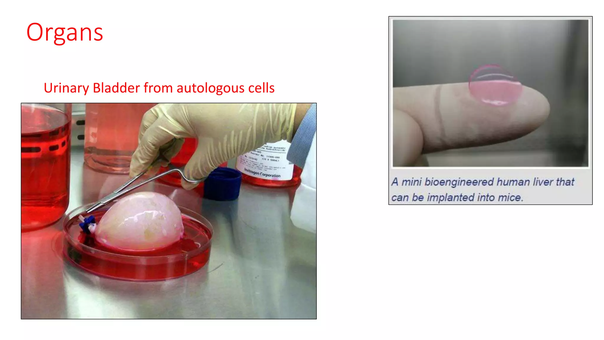 Organs
Urinary Bladder from autologous cells
 