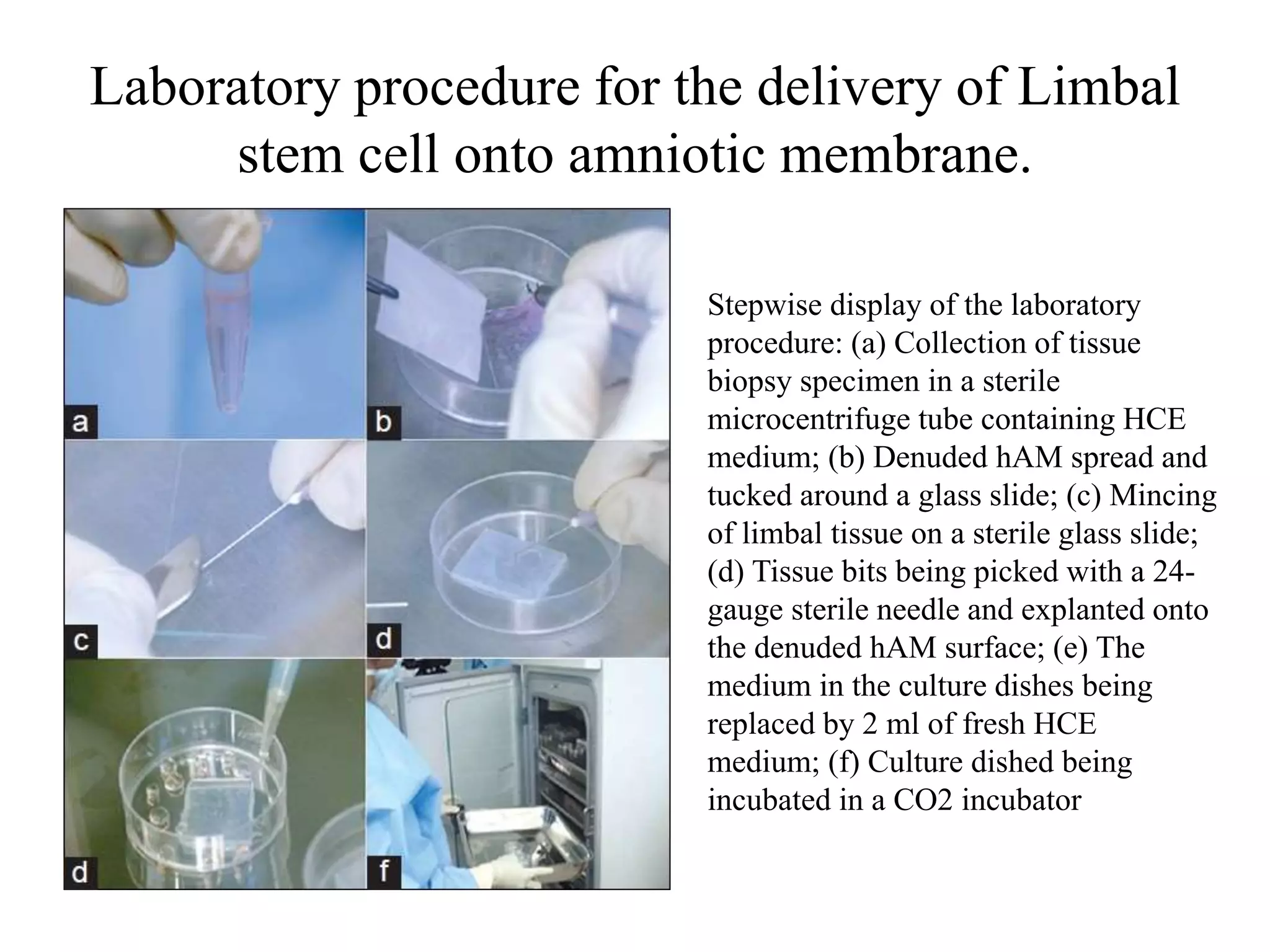Laboratory procedure for the delivery of Limbal
stem cell onto amniotic membrane.
Stepwise display of the laboratory
procedure: (a) Collection of tissue
biopsy specimen in a sterile
microcentrifuge tube containing HCE
medium; (b) Denuded hAM spread and
tucked around a glass slide; (c) Mincing
of limbal tissue on a sterile glass slide;
(d) Tissue bits being picked with a 24-
gauge sterile needle and explanted onto
the denuded hAM surface; (e) The
medium in the culture dishes being
replaced by 2 ml of fresh HCE
medium; (f) Culture dished being
incubated in a CO2 incubator
 