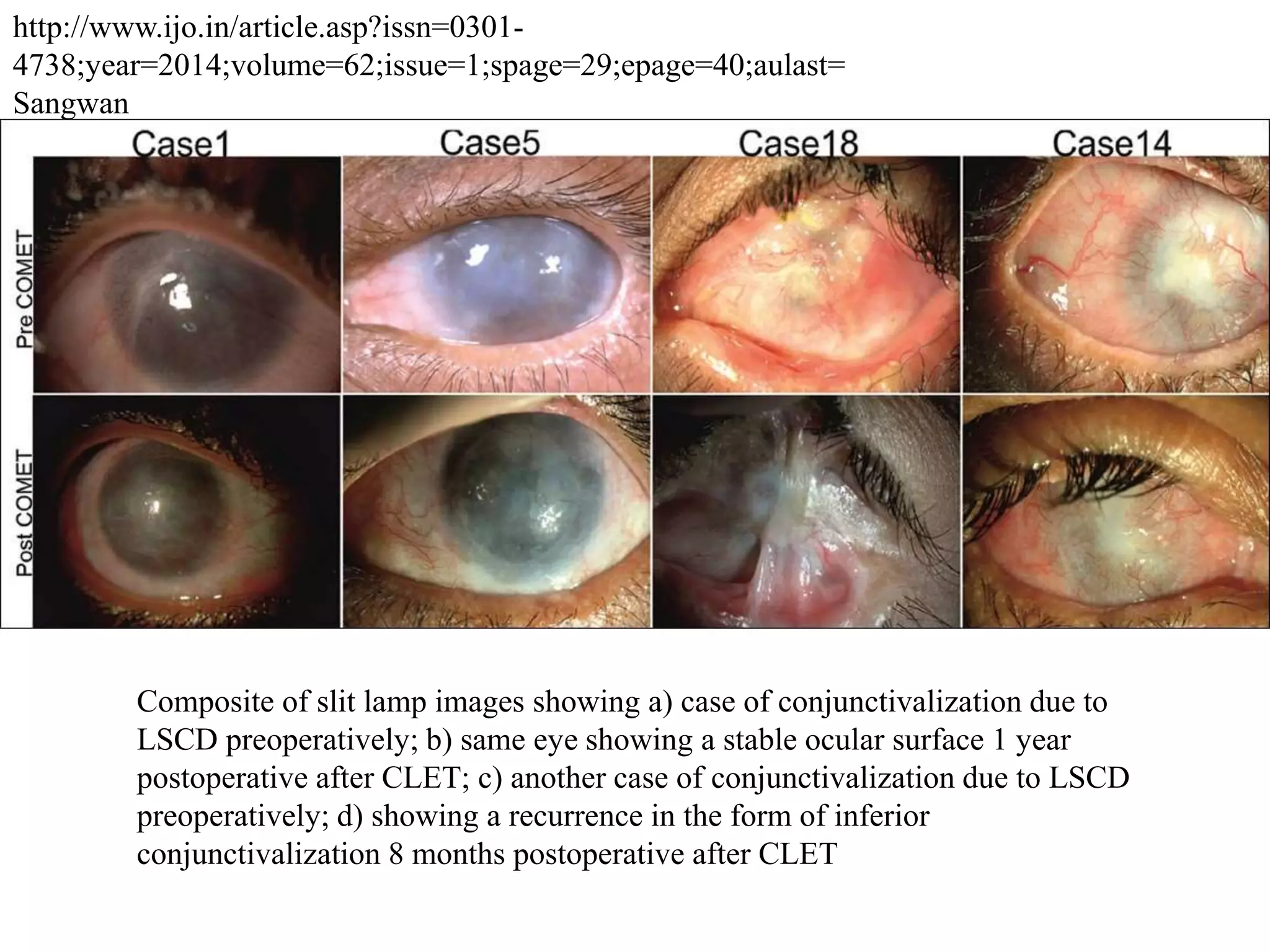 Composite of slit lamp images showing a) case of conjunctivalization due to
LSCD preoperatively; b) same eye showing a stable ocular surface 1 year
postoperative after CLET; c) another case of conjunctivalization due to LSCD
preoperatively; d) showing a recurrence in the form of inferior
conjunctivalization 8 months postoperative after CLET
http://www.ijo.in/article.asp?issn=0301-
4738;year=2014;volume=62;issue=1;spage=29;epage=40;aulast=
Sangwan
 