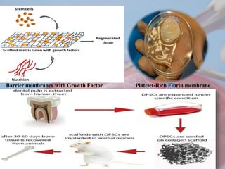 Barrier membranes with Growth Factor Platelet-Rich Fibrin membrane
 