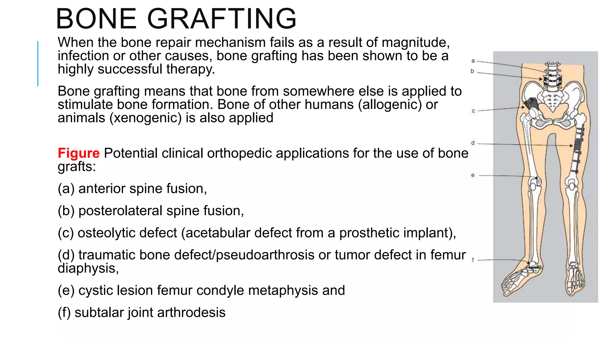 BONE GRAFTING
When the bone repair mechanism fails as a result of magnitude,
infection or other causes, bone grafting has been shown to be a
highly successful therapy.
Bone grafting means that bone from somewhere else is applied to
stimulate bone formation. Bone of other humans (allogenic) or
animals (xenogenic) is also applied
Figure Potential clinical orthopedic applications for the use of bone
grafts:
(a) anterior spine fusion,
(b) posterolateral spine fusion,
(c) osteolytic defect (acetabular defect from a prosthetic implant),
(d) traumatic bone defect/pseudoarthrosis or tumor defect in femur
diaphysis,
(e) cystic lesion femur condyle metaphysis and
(f) subtalar joint arthrodesis

 