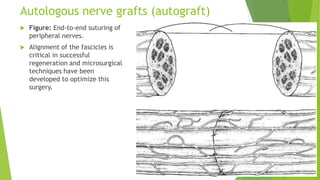 Autologous nerve grafts (autograft)


Figure: End-to-end suturing of
peripheral nerves.



Alignment of the fascicles is
critical in successful
regeneration and microsurgical
techniques have been
developed to optimize this
surgery.

 