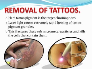 o Here tattoo pigment is the target chromophore.
o Laser light causes extremely rapid heating of tattoo
pigment granules.
o This fractures these sub micrometer particles and kills
the cells that contain them.
 