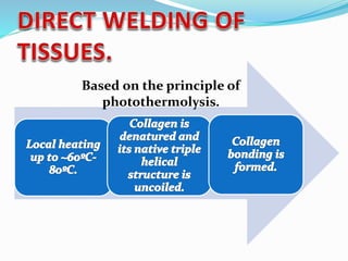 Based on the principle of
photothermolysis.
 
