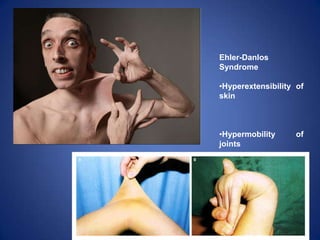 Ehler-Danlos
Syndrome
•Hyperextensibility of
skin
•Hypermobility of
joints
 