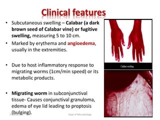 Clinical features
• Subcutaneous swelling – Calabar (a dark
brown seed of Calabar vine) or fugitive
swelling, measuring 5 to 10 cm.
• Marked by erythema and angioedema,
usually in the extremities.
• Due to host inflammatory response to
migrating worms (1cm/min speed) or its
metabolic products.
• Migrating worm in subconjunctival
tissue- Causes conjunctival granuloma,
edema of eye lid leading to proptosis
(bulging).
7/9/2021 Dept of Microbiology 50
 