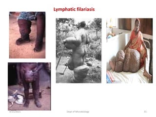 Lymphatic filariasis
9/21/2021 Dept of Microbiology 31
 