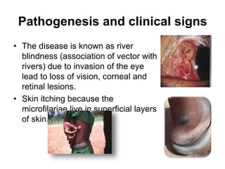 Pathogenesis and clinical signs
• The disease is known as river
blindness (association of vector with
rivers) due to invasion of the eye
lead to loss of vision, corneal and
retinal lesions.
• Skin itching because the
microfilariae live in superficial layers
of skin.
 