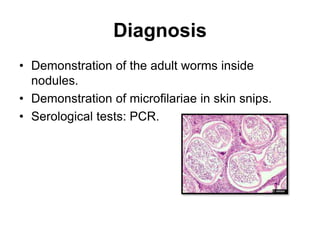 Diagnosis
• Demonstration of the adult worms inside
nodules.
• Demonstration of microfilariae in skin snips.
• Serological tests: PCR.
 