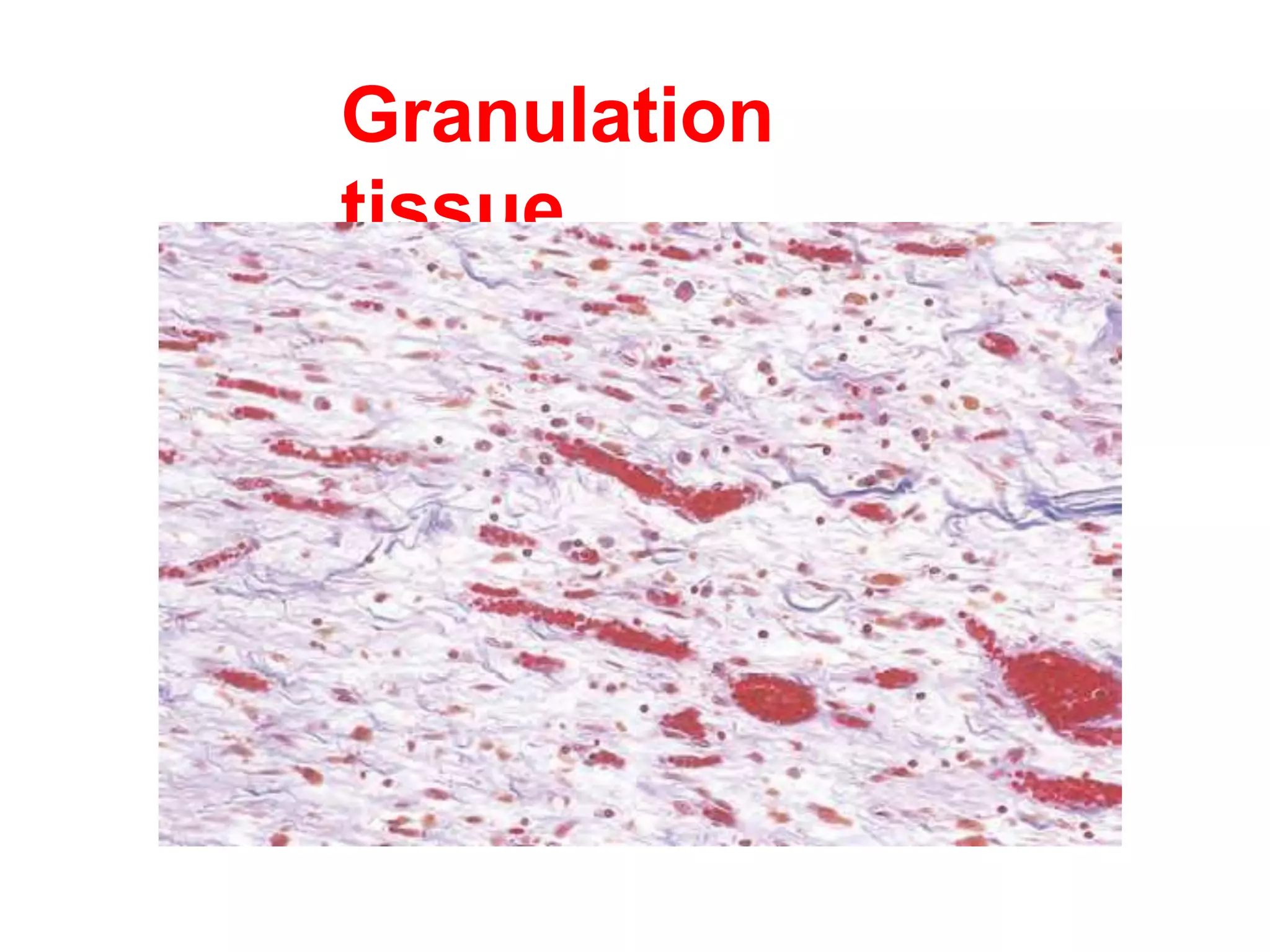 Granulation
tissue
 