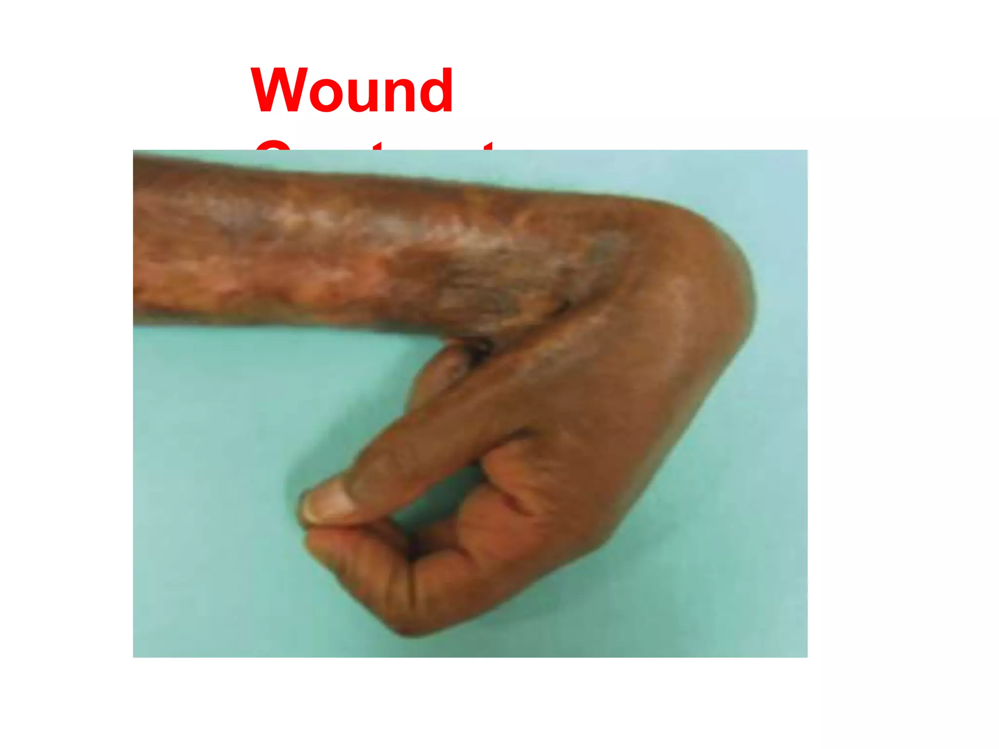 Wound
Contracture
 