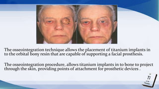 The osseointegration technique allows the placement of titanium implants in
to the orbital bony resin that are capable of supporting a facial prosthesis.
The osseointegration procedure, allows titanium implants in to bone to project
through the skin, providing points of attachment for prosthetic devices .
 