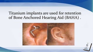 Titanium implants are used for retention
of Bone Anchored Hearing Aid (BAHA) .
 