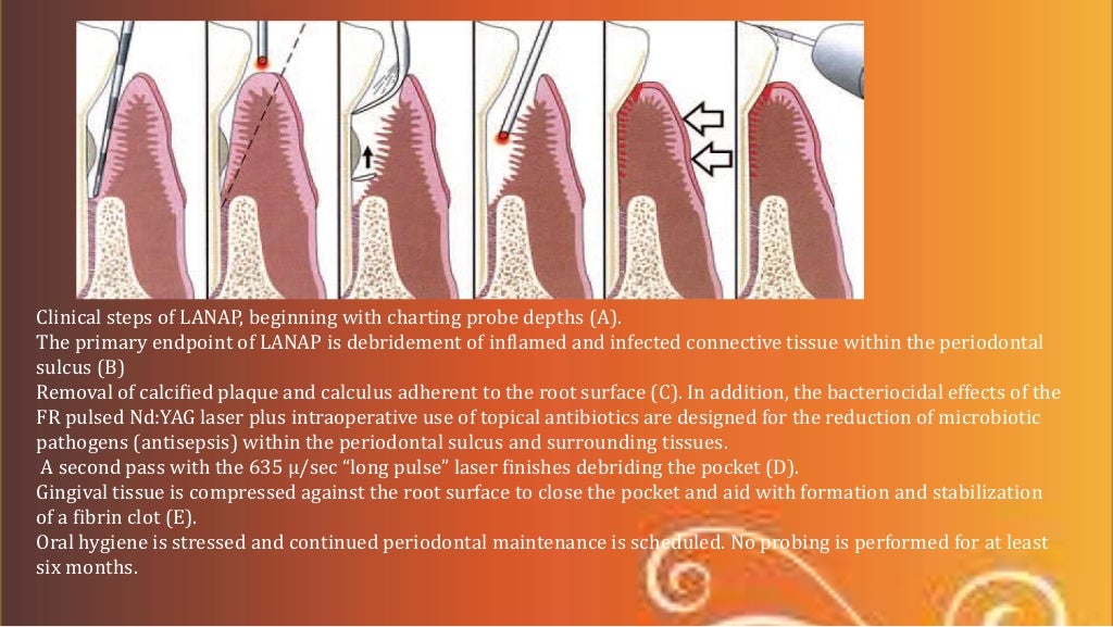 periodontal flap surgeries