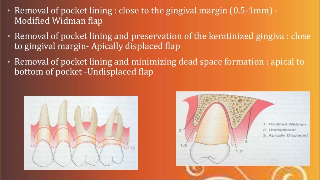periodontal flap surgeries