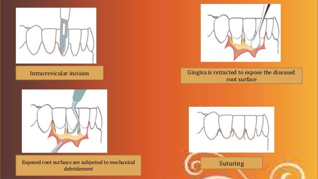 crown lengthening