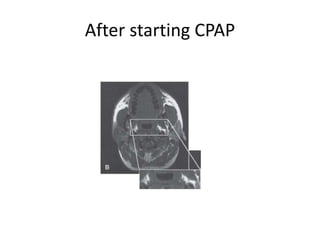 Titration study in sleep lab | PPTX