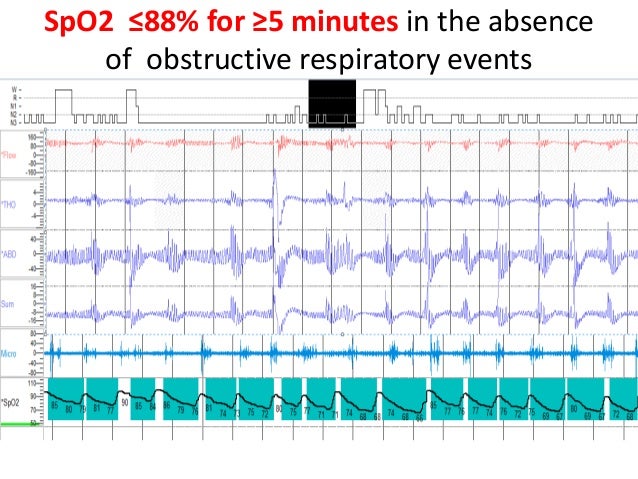Titration Sleep Study: Cpap Titration – Netzdot