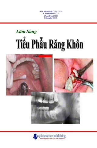 tiểu phẫu răng khôn.pdf