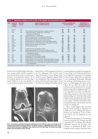 betweenthesizeandtheshapeoftheabnor-
mal contrast outline, and this resulted in
some lesions being missed on initial inter-
pretation. At retrospective analysis, 10 of
14 meniscal injuries were correctly diag-
nosed (Table 2). It was not possible to
see any evidence of injury in the four dam-
aged menisci, which appeared normal on
the CT arthrogram. One of these scans
(dog 15) had poor contrast ﬁlling, which
resulted in poor diagnostic quality which
was considered to have hindered interpre-
tation. The three other dogs (dogs 5, 9 and
10) had scans of diagnostic quality, but no
meniscal injury was evident at retrospective
review. Dogs 5 and 9 had tears which were
non-displaced in association with damage
to the meniscus which had not resulted in
a tear (crushing or thickening). Although
the crushing or thickening was seen at sur-
gery, we would suggest that these sorts of
injury do not affect the outline of the
meniscus and would therefore be very dif-
ﬁcultorimpossibletodiagnoseusingCTA.
The tears present in these two dogs were
most likely not seen as they were not dis-
placed. Dog 10 was unusual, in that a small
bucket handle tear, along the axial margin
ofthemeniscus,had beenremovedatapre-
vious surgery. Therefore, the outline of the
meniscus was intact, and no lesion was seen
on the CT arthrogram.
These results suggest that meniscal
lesions which are large or displaced are
readily seen on CT arthrograms, whereas
injuries not resulting in a tear or those
tears which are not displaced are not
apparent.
Atinitialinterpretation,CTAwasfound
to have a sensitivity of 57 to 64 per cent and
a speciﬁcity of 71 to 100 per cent with fair
agreement between the reviewers. The
accuracy as determined by ROC curve
analysis was fair to good. A previous study
Table 2. Arthrotomy ﬁndings and the results of the blinded and retrospective reviews
Dog Degree of
cruciate
rupture
Meniscal
injury?
Surgical ﬁndings including
injury to medial meniscus
Reviewer identiﬁcation
of meniscal injury
Identiﬁcation of
meniscal injury on
retrospective review?
1 2 3
1 Partial No No No No No
2 Full No Tibial plateau levelling osteotomy implants removed No No No No
3 Full Yes Longitudinal tear to caudal pole. Cranial pole
thickened and abnormal
Yes No No Yes
4 Full Yes Longitudinal tear to caudal pole Yes No Yes Yes
5 Full Yes Bucket handle tear and crushing of caudal pole No Yes No No
6 Full No Synovial inﬂammation, marked periarticular ﬁbrosis No No No No
7 Partial No Inﬂammation and ﬁbrosis around nylon suture No No No No
8 Full Yes Multiple tears in caudal pole. Caudal pole folded forward Yes Yes Yes Yes
9 Partial Yes Caudal pole torn but non-displaced. Cranial pole thickened Yes No No No
10 Full Yes Previous bucket handle tear removed No Yes No No
11 Partial Yes Small transverse tear No Yes Yes Yes
12 Full No No No No No
12 Full Yes Caudal pole torn and folded cranially Yes Yes Yes Yes
13 Partial No Mineralised fragment in meniscus. Patellar luxation No Yes No No
14 Full No Marked periarticular ﬁbrous reaction and ﬁbrous reaction
associated with graft
No Yes No No
15 Full Yes Very small longitudinal tear No Yes No No
16 Full Yes Caudal pole torn and folded cranially Yes Yes Yes Yes
17 Full Yes Caudal pole torn and folded cranially Yes Yes Yes Yes
18 Full Yes Whole medial meniscus crushed. Caudal pole folded cranially Yes Yes Yes Yes
19 Partial Yes Longitudinal tear to caudal pole. Caudal pole folded cranially No No Yes Yes
20 Full Yes Bucket handle tear to mid meniscus. Caudal pole detached
but non-displaced
No No No Yes
Bold denotes correct interpretation of computed tomographic arthrogram by reviewer
FIG 2. Dorsal plane computed tomography arthrograms of the stiﬂe from dog 1 (a) and dog 13 (b)
showing normal medial and lateral menisci. The lateral meniscus is highlighted with a white arrow,
and the medial meniscus is highlighted with a black arrow in the ﬁrst image. The menisci are wedge
shaped and surrounded by white contrast
328 Journal of Small Animal Practice Á Vol 50 ÁJuly 2009 ÁÓ 2009 British Small Animal Veterinary Association
M. S. Tivers and others
 