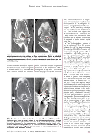 onsimulatedmeniscalinjuryhadsuggested
that the accuracy of CTA would be greater
(Tivers and others 2008). There was also
some variation between the reviewers’
results. None of the reviewers had previous
experience in the interpretation of CT
arthrograms in dogs with CCLI or late
meniscal injury. It is likely that this inexpe-
rience contributed to variation in interpre-
tation between reviewers. The effectiveness
of interpretation of CT arthrograms im-
proved at retrospective review with a sensi-
tivity of 71 per cent, a speciﬁcity of 100 per
cent and good accuracy as determined by
ROC curve analysis. This suggests that
the interpretation of CT arthrograms has
a steep learning curve but that with some
experience, it is an accurate technique for
the diagnosis of medial meniscal injury
in the dog.
CTA of the human knee is reported to
have a sensitivity of 92 to 100 per cent
anda speciﬁcityof78to94percent(Vande
Bergandothers2000,2002,Mutschlerand
others 2003), varying with the type of
meniscal injury and whether previous sur-
gery has been performed. These studies
used a dual detector helical CT unit, which
allowed reformatting of images with min-
imal loss of quality. Similarly to our study,
‘‘a meniscal abnormality was deﬁned bythe
presence of contour irregularity, peripheral
separation, or tear of a meniscus’’ (Vande
Berg and others 2000). Although the accu-
racy reported in our study compares well
with that in the human literature, it is clear
that CTA is able to detect much more sub-
tle lesions in people. This discrepancy
could be related to the quality of the scans
produced by the CT machine used; 1Á5-
mm thick slices were obtained which
resultedinasigniﬁcantlossofimagequality
whenreformattingfromthedorsalplane.It
is likely that the use of a 16-slice multi-
detectorCTscannerwouldproduceimages
of greater quality and diagnostic potential.
The image quality could also be improved
byusingsmallerslicethicknessandoverlap-
ping slices, allowing reconstruction of sag-
ittal or transverse images of much higher
quality. This would facilitate the detection
of smaller and more subtle lesions.
A previous study investigated the use of
transverse CTA scans for the diagnosis of
injuries to the cruciate ligaments and
menisci (Samii and others 2009). They
found a sensitivity of 13Á3 to 73Á3 per cent
and a speciﬁcity of 57Á1 to 100 per cent for
the diagnosis of meniscal tears. Sensitivity
was 64Á3 per cent and speciﬁcity was 73Á3
per cent on consensus evaluation. The
results in our current study compare
favourably with these ﬁndings and would
support the use of dorsal plane scans over
FIG 3. Dorsal plane computed tomography arthrograms of the stiﬂe from dog 12 before surgery (a)
and six weeks after surgery (b) for rupture of the cranial cruciate ligament. In image (a), the medial
meniscus has a normal outline. In image (b), the medial meniscus has an axial bulge and has lost its
normal wedge-shaped appearance (red ring). At surgery, the caudal pole of the meniscus was torn
and folded cranially
FIG 4. Dorsal plane computed tomography arthrograms of the stiﬂe from dog 7 (a) showing the
fabellotibial suture crimps and dog 2 (b) showing the tibial plateau levelling osteotomy (TPLO) plate
and screws. The crimps produce a minimal amount of streak artefact, which does not obscure the
intra-articular structures. The TPLO implants produce a much greater amount of artefact, which
interferes with the view of the joint. However, the artefact is inconsistent on the different slices, and
it is possible to still achieve a diagnostic scan of the joint. In this example, the medial meniscus is
clearly seen, despite the artefact (red ring)
Journal of Small Animal Practice Á Vol 50 ÁJuly 2009 ÁÓ 2009 British Small Animal Veterinary Association 329
Diagnostic accuracy of stiﬂe computed tomography arthrography
 
