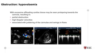 With excessive offloading cardiac tissue may be seen prolapsing towards the
cannula, resulting in:
• partial obstruction
• high Doppler velocities
• associated with juddering of the cannulae and swings in flows
Cannula with thrombus
Obstruction: hypovolaemia
 