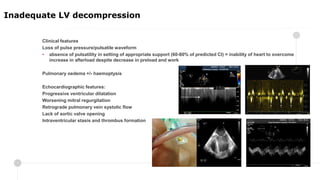 Clinical features
Loss of pulse pressure/pulsatile waveform
• absence of pulsatility in setting of appropriate support (60-80% of predicted CI) = inability of heart to overcome
increase in afterload despite decrease in preload and work
Pulmonary oedema +/- haemoptysis
Echocardiographic features:
Progressive ventricular dilatation
Worsening mitral regurgitation
Retrograde pulmonary vein systolic flow
Lack of aortic valve opening
Intraventricular stasis and thrombus formation
Inadequate LV decompression
 