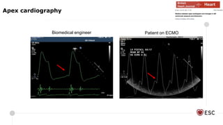 Biomedical engineer Patient on ECMO
Apex cardiography
 