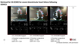 Retrieval for VA ECMO for severe biventricular heart failure following
OOHCA
3.3 L VA ECMO Support
4 Chamber Longitudinal strain
= -14.7%
LVOT VTI = 13.6
3.0 L VA ECMO Support
4 Chamber Longitudinal
strain = -17.3%
LVOT VTI = 12.4
1.0 L VA ECMO Support
4 Chamber Longitudinal
strain = -17.9%
LVOT VTI = 14
Dr Alessia Gambaro, with permission
 
