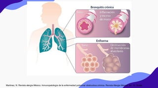 Martinez, N. Revista alergia México. Inmunopatología de la enfermedad pulmonar obstructiva crónica. Revista Alergia México, 64, 10. Scielo.
 