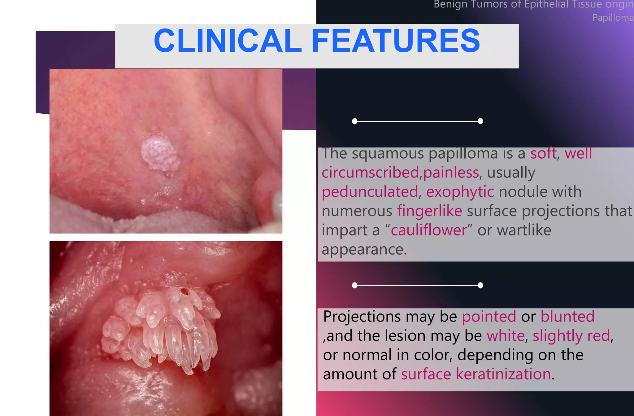 benign-tumors-of-oral-cavity-sonal-pptx