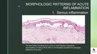 z
1. Serous inflammation
 Serous inflammation is marked by the exudation of cell poor fluid into
spaces created by cell injury or into body cavities lined by the peritoneum,
pleura, or pericardium.
 Typically, the fluid in serous inflammation is not infected by destructive
organisms and does not contain large numbers of leukocytes (which tend to
produce purulent inflammation, described later).
 In body cavities the fluid may be derived from the plasma (as a result of
increased vascular permeability) or from the secretions of mesothelial cells
(as a result of local irritation); accumulation of fluid in these cavities is called
an effusion. (Effusions also occur in noninflammatory conditions, such as
reduced blood outflow in heart failure, or reduced plasma protein levels in
some kidney and liver diseases.)
 The skin blister resulting from a burn or viral infection represents
accumulation of serous fluid within or immediately beneath the damaged
epidermis of the skin
MORPHOLOGIC PATTERNS OF ACUTE
INFLAMMATION
 
