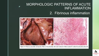 z
 With greater increase in vascular permeability, large molecules
such as fibrinogen pass out of the blood, and fibrin is formed
and deposited in the extracellular space.
 A fibrinous exudate is characteristic of inflammation in the lining
of body cavities, such as the meninges, pericardium and pleura.
 Conversion of the fibrinous exudate to scar tissue (organization)
within the pericardial sac leads to obliteration of the pericardial
space.
2. Fibrinous inflammation
MORPHOLOGIC PATTERNS OF ACUTE
INFLAMMATION
 