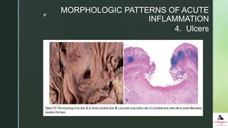 z
 An ulcer is a local defect, or excavation, of the surface of an
organ or tissue that is produced by the sloughing
(shedding) of inflamed necrotic tissue
 Ulcerations are best exemplified by peptic ulcer of the stomach
or duodenum, in which acute and chronic inflammation coexist.
 During the acute stage there is intense polymorphonuclear
infiltration and vascular dilation in the margins of the defect.
 With chronicity, the margins and base of the ulcer develop
fibroblastic proliferation, scarring, and the accumulation of
lymphocytes, macrophages, and plasma cells.
4. Ulcers
MORPHOLOGIC PATTERNS OF ACUTE
INFLAMMATION
 
